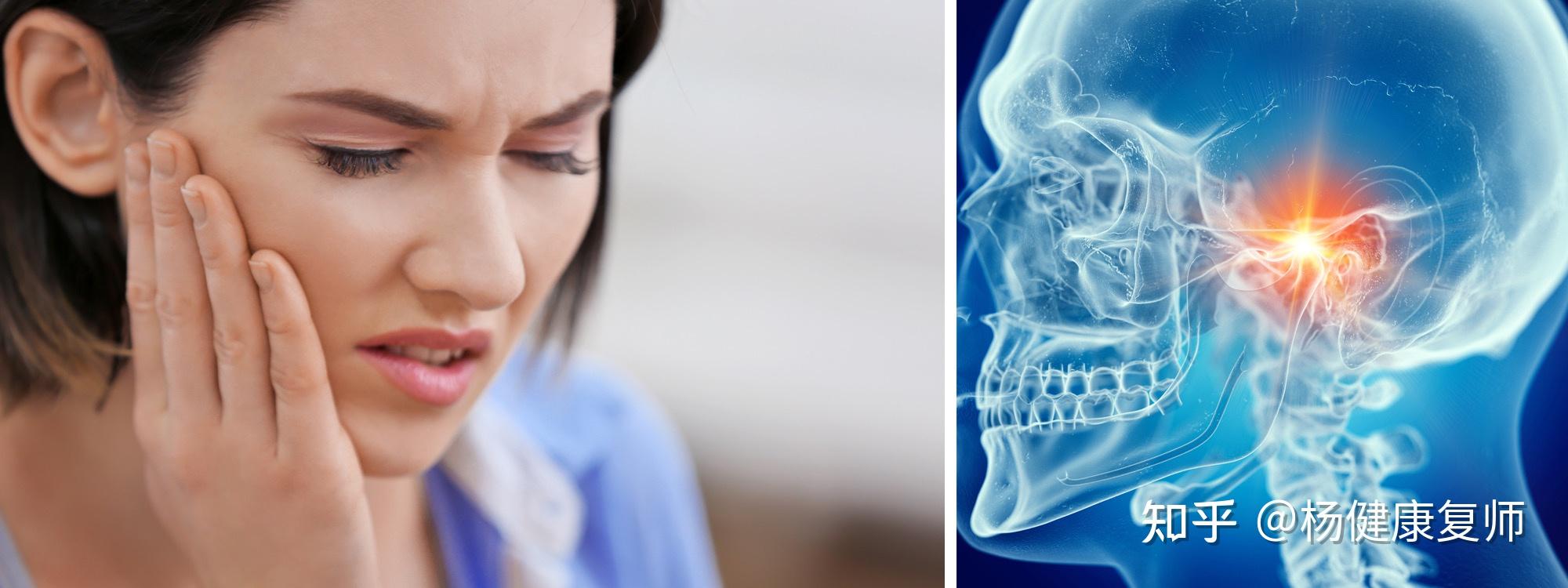 颞下颌关节紊乱综合征的物理治疗