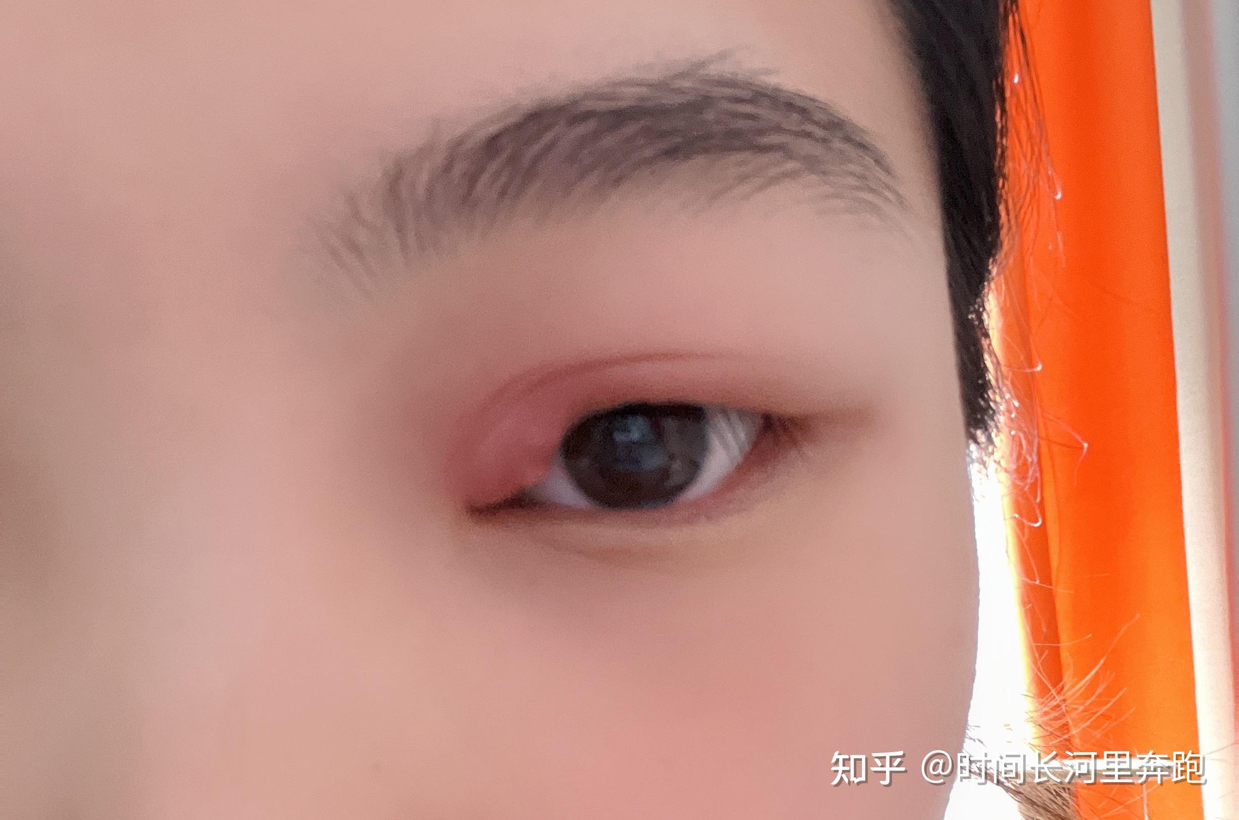 我得麦粒肿了记录一下一定要热敷热敷热敷