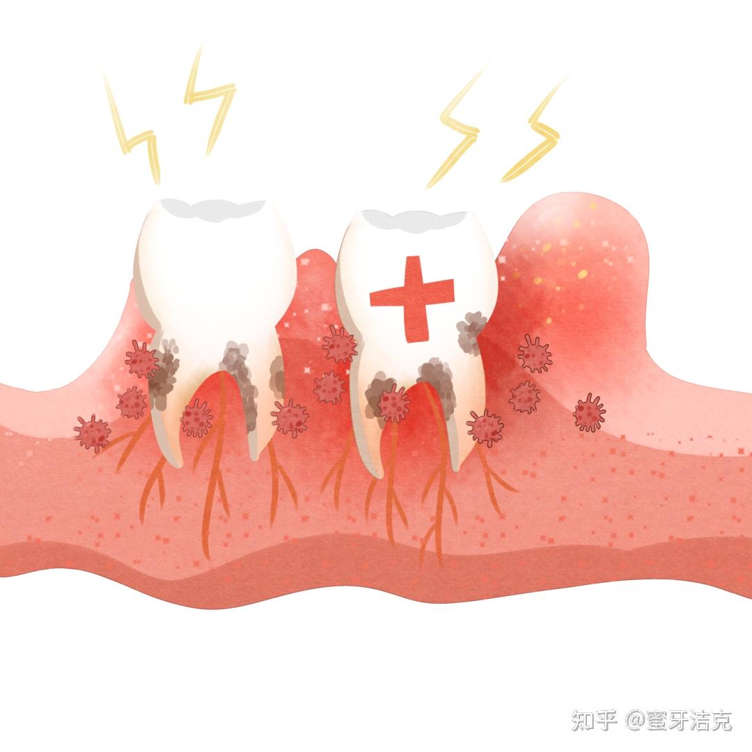 很多人因為害怕出血而不敢認真刷牙,食物殘渣積累的越來越多,牙齦炎