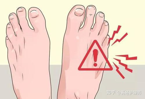 不过了,一个迟迟不愈合的坏疽伤口为什么能引发如此强烈的健康损伤?