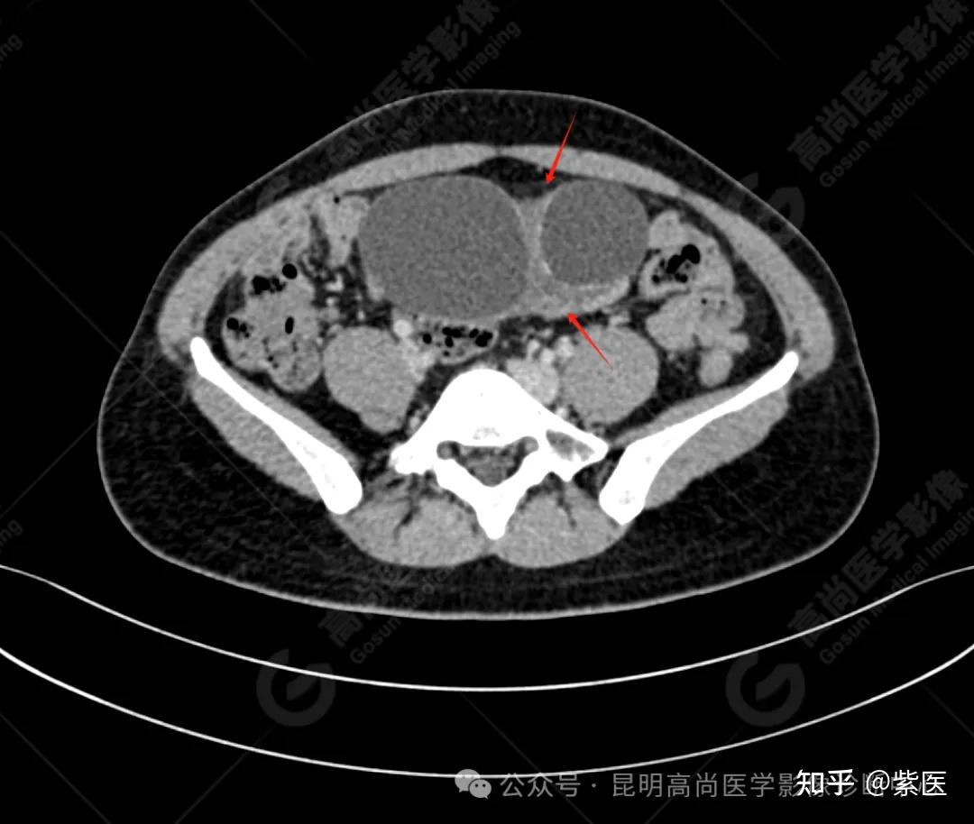 卵巢囊腺瘤ct表现图片图片