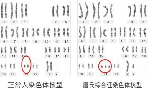什么是基因遗传病 v2-e971118887c74bf776ad4f4e1c9607c2_r.jpg