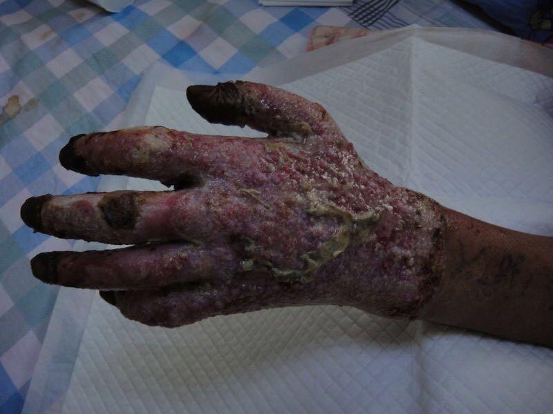 烧伤烫伤骨折全康复