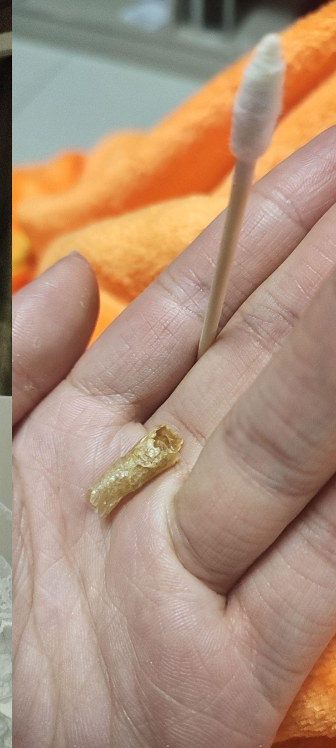 耳屎最大能有多大