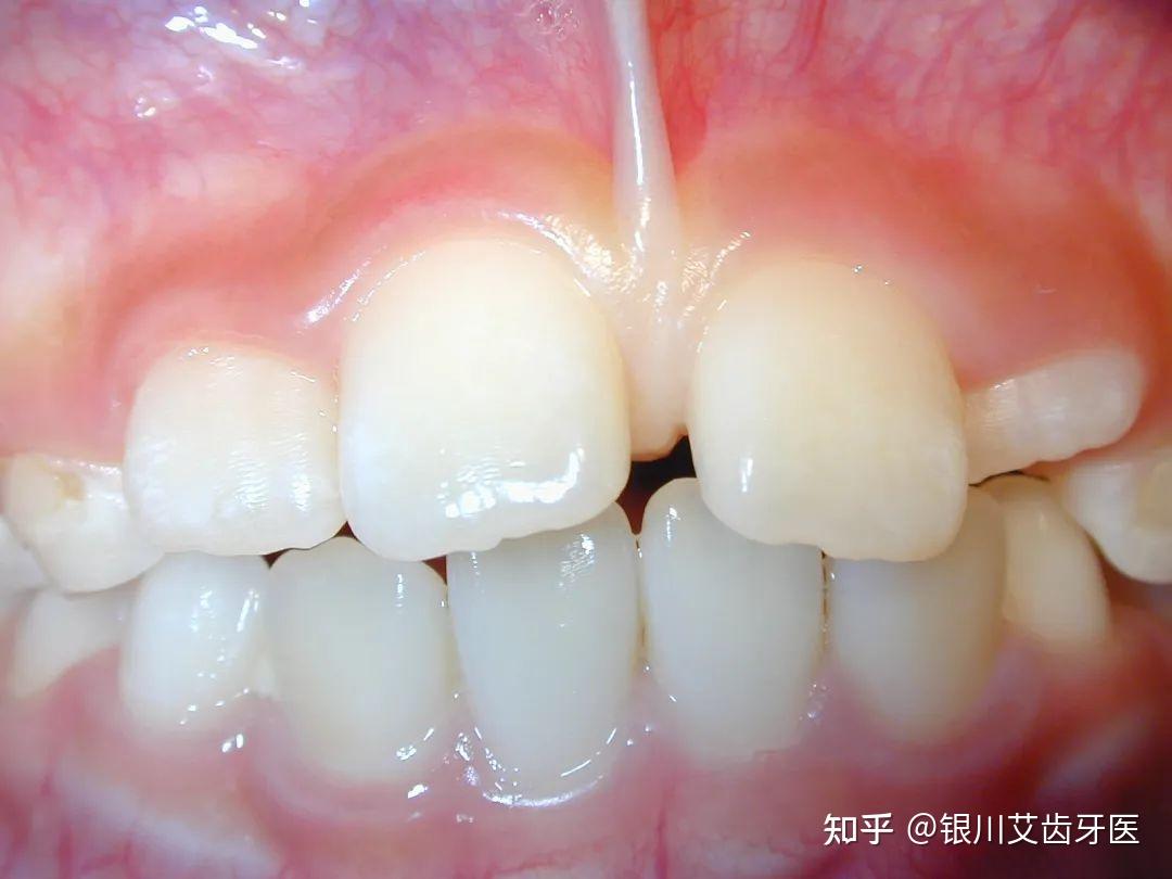 长期使用牙线，牙齿缝隙会不会变大？ - 知乎