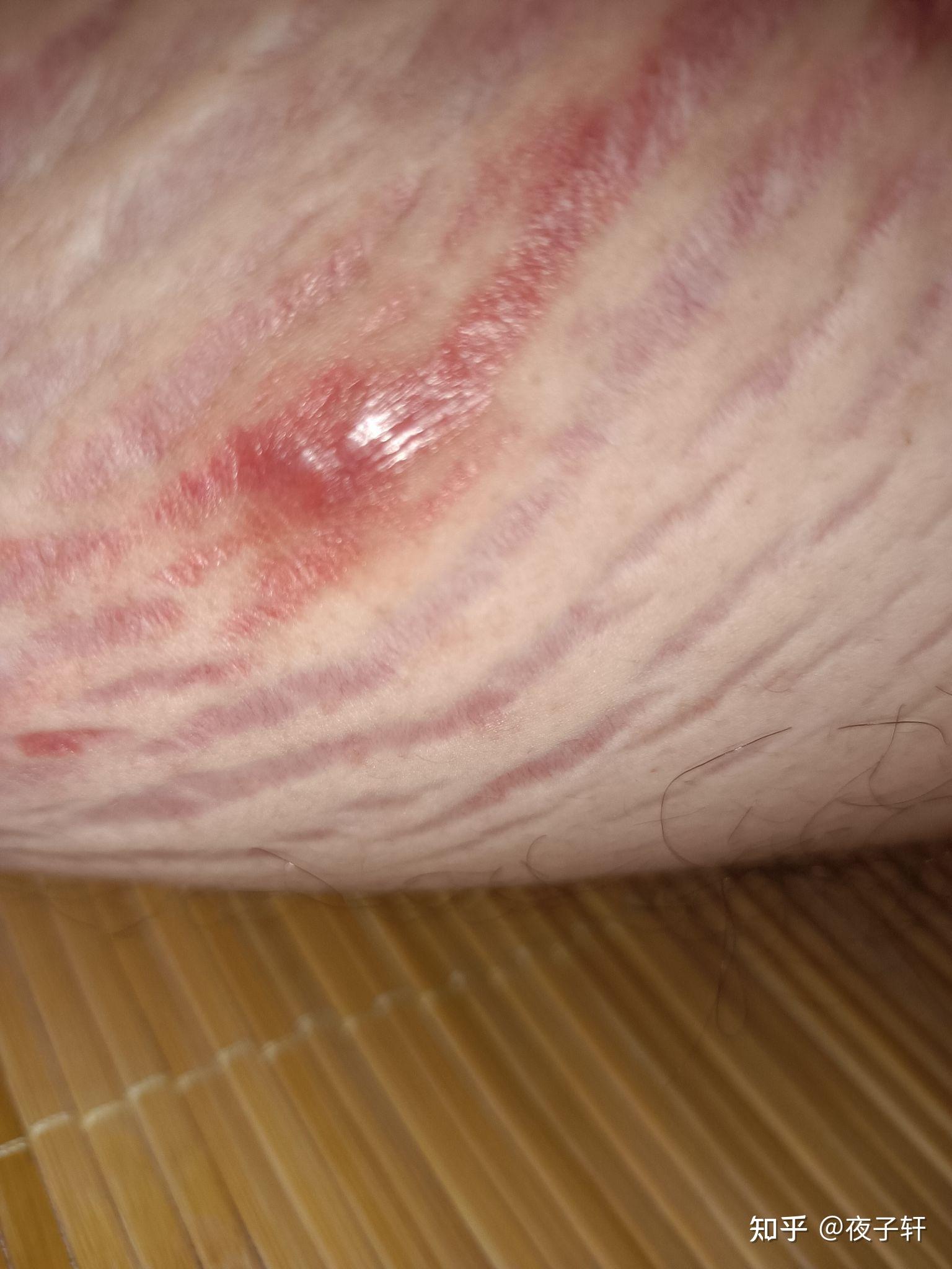 大腿内侧有这样红色的斑但是不痒,这是什么症状?