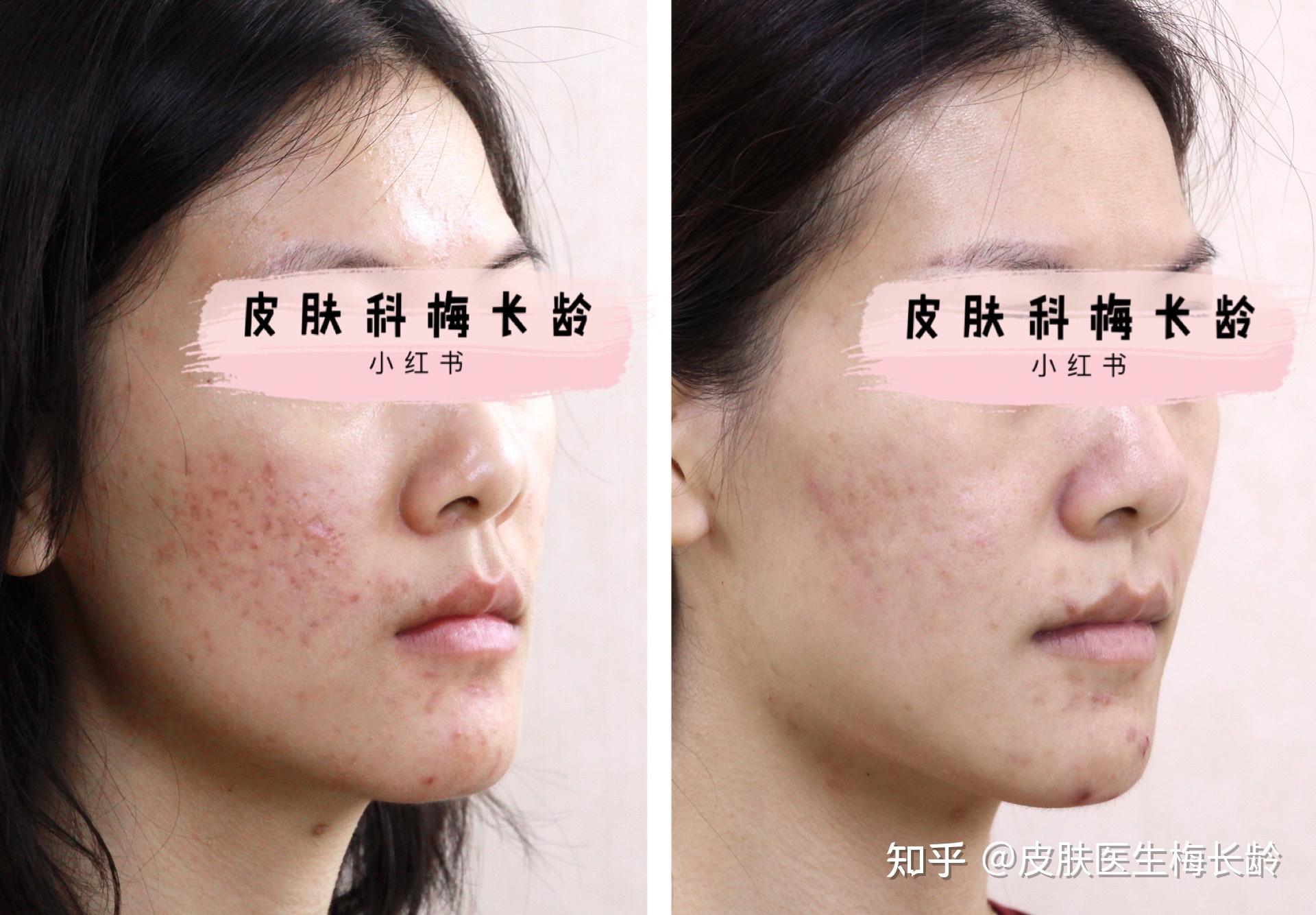拯救被激光毁掉的痘坑脸