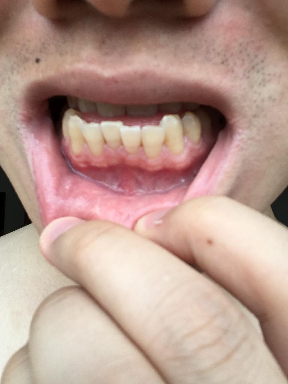 牙龈萎缩图片 初期图片