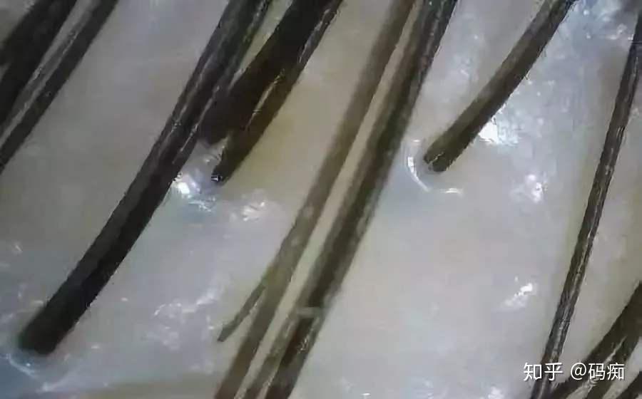 关于脱发,正常的头皮与非正常头皮环境的影响