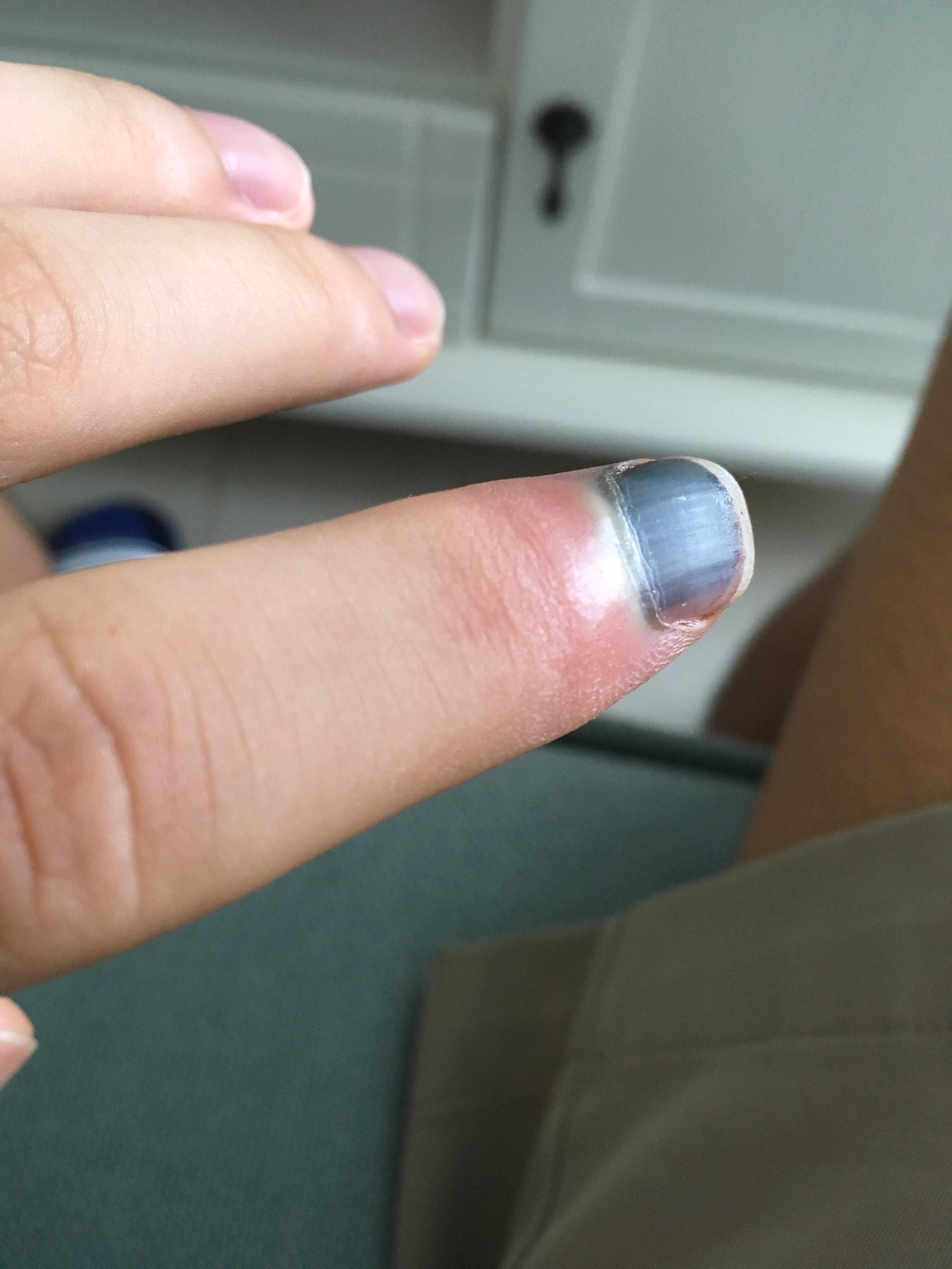手指被门夹了然后指甲里面四分之一有淤血都两个月了还没好怎么办求助