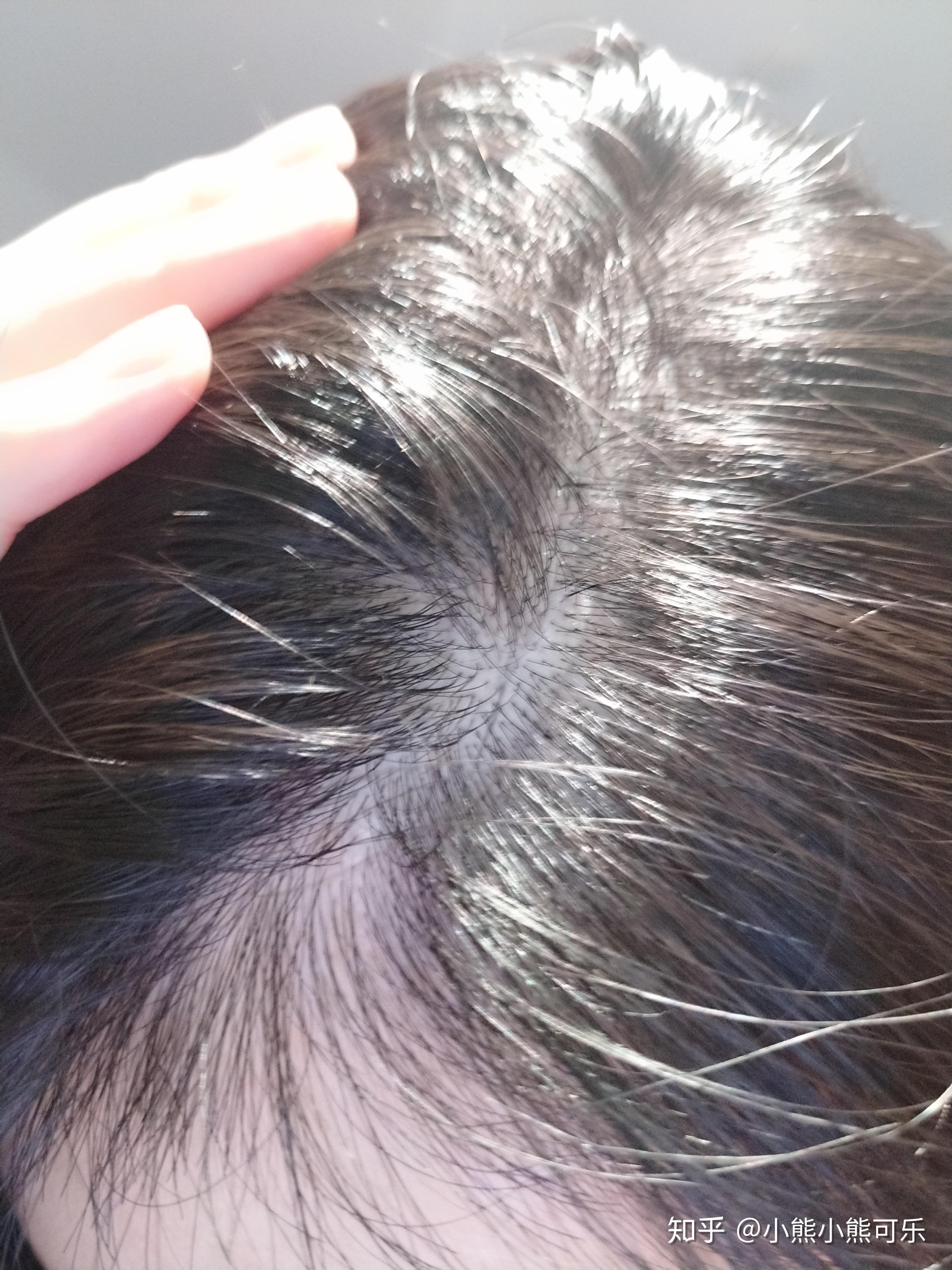 女生发量少头顶快秃了有没有什么好的生发方法跪求