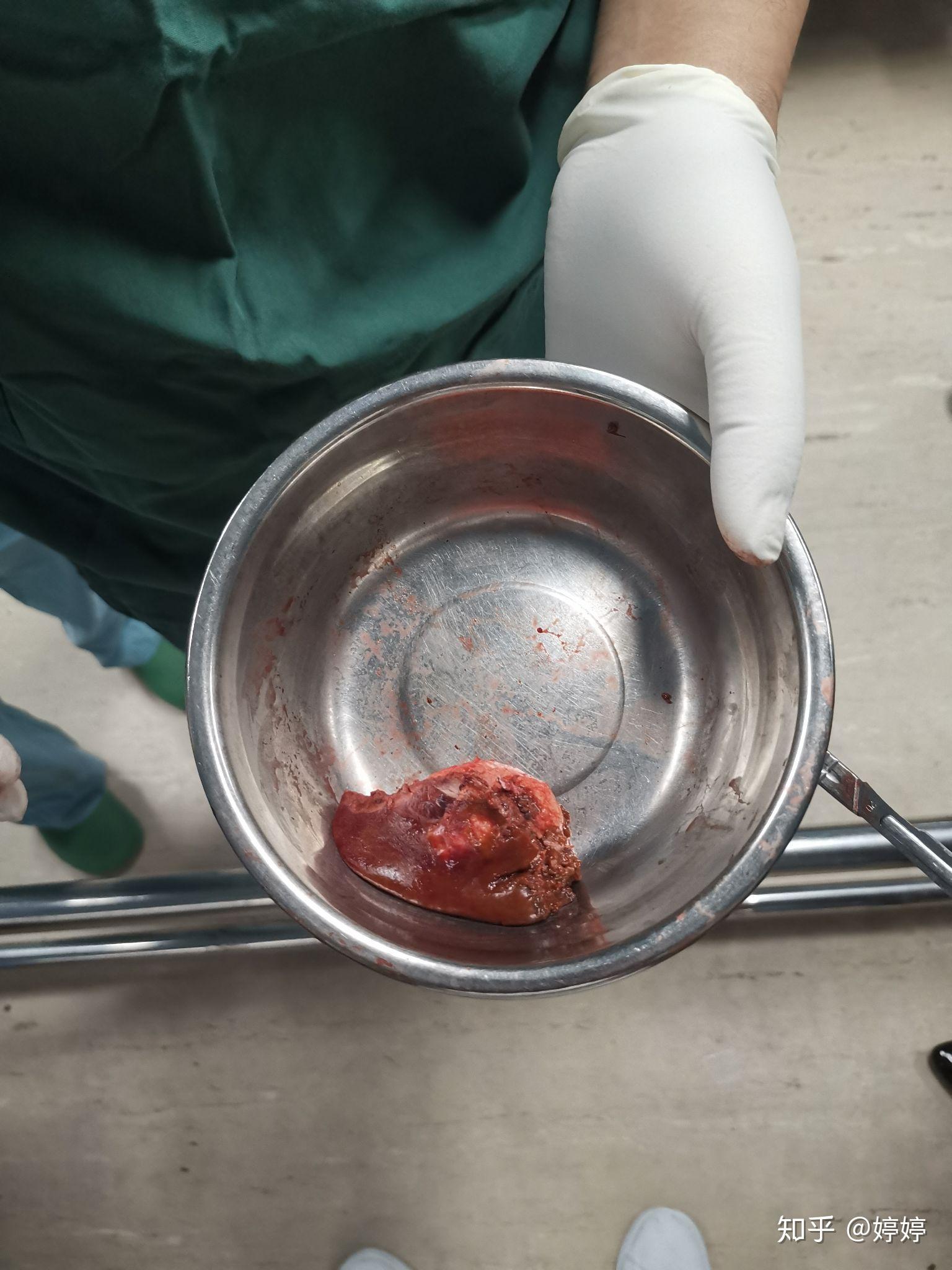 mark自己经历的肝脏肿瘤手术经历 - 知乎