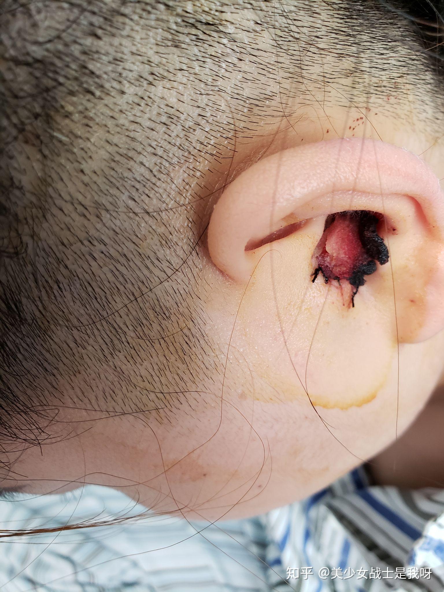 鼓膜穿孔修补手术有人了解么具体有哪些风险