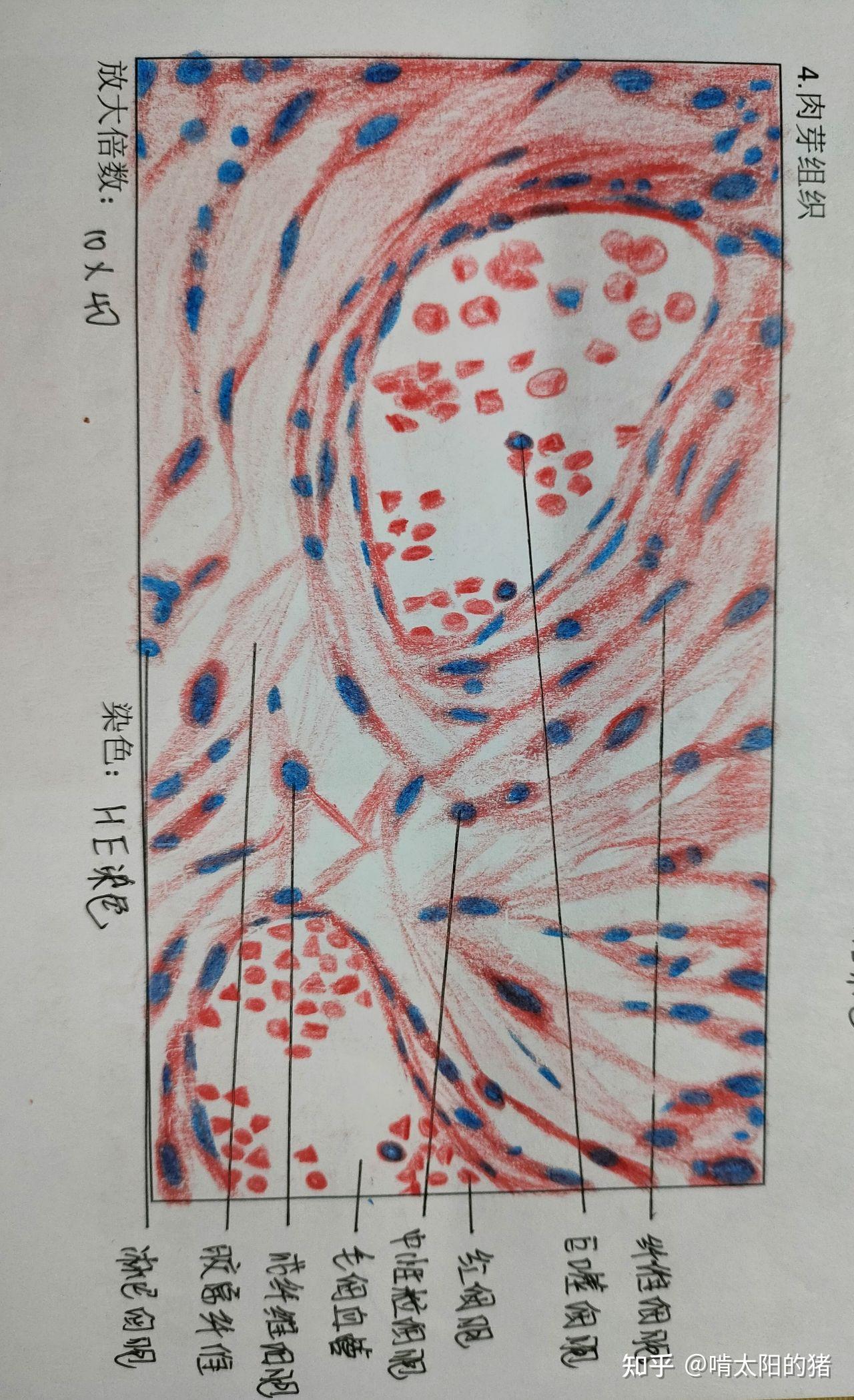 病理肉芽组织红蓝绘图图片