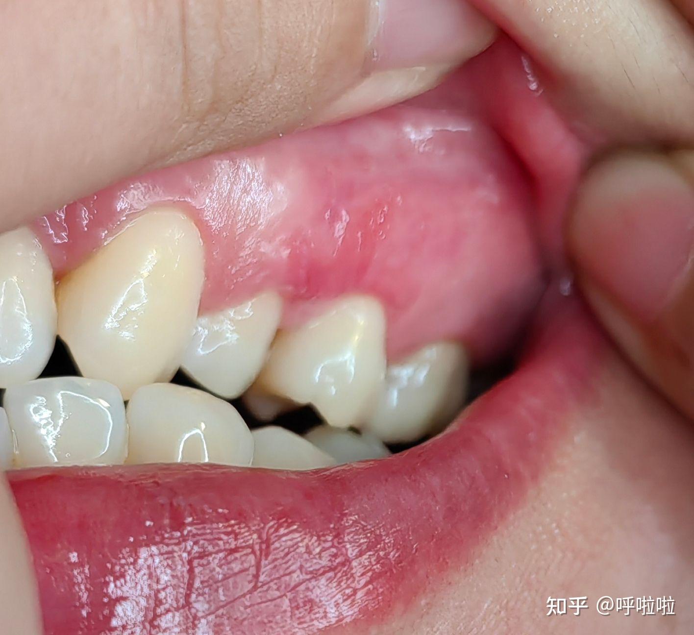 口腔黏膜扁平苔藓伴随了我10年 - 知乎