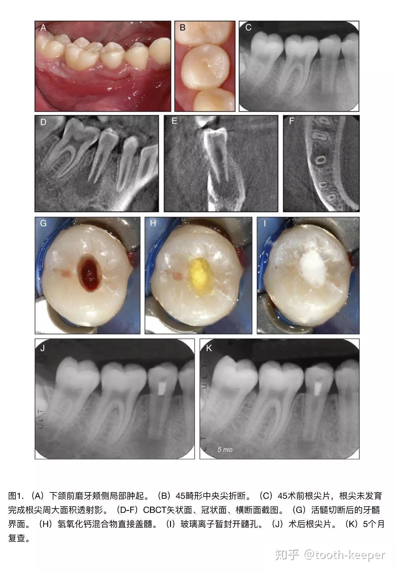 Root Fracture-牙根裂掉 | 高雄根管治療專家-牙髓病專科王俊欽牙醫師