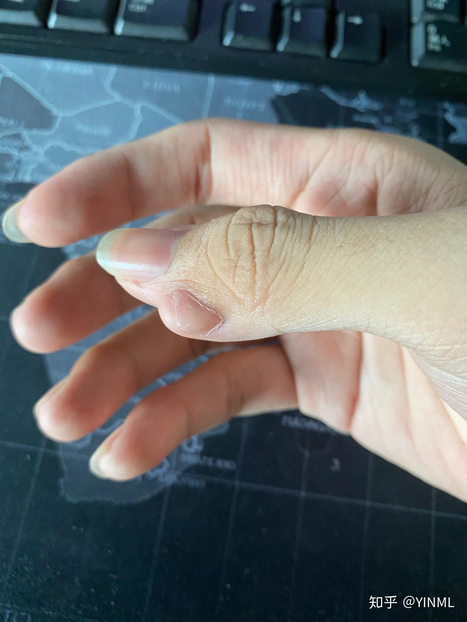 一只手有六个手指是种怎样的体验