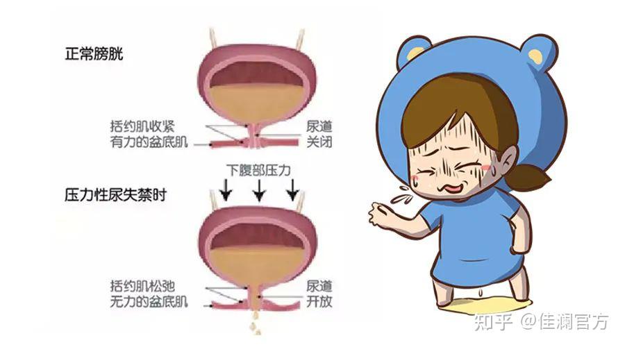 漏尿，一种难言之隐 - 知乎