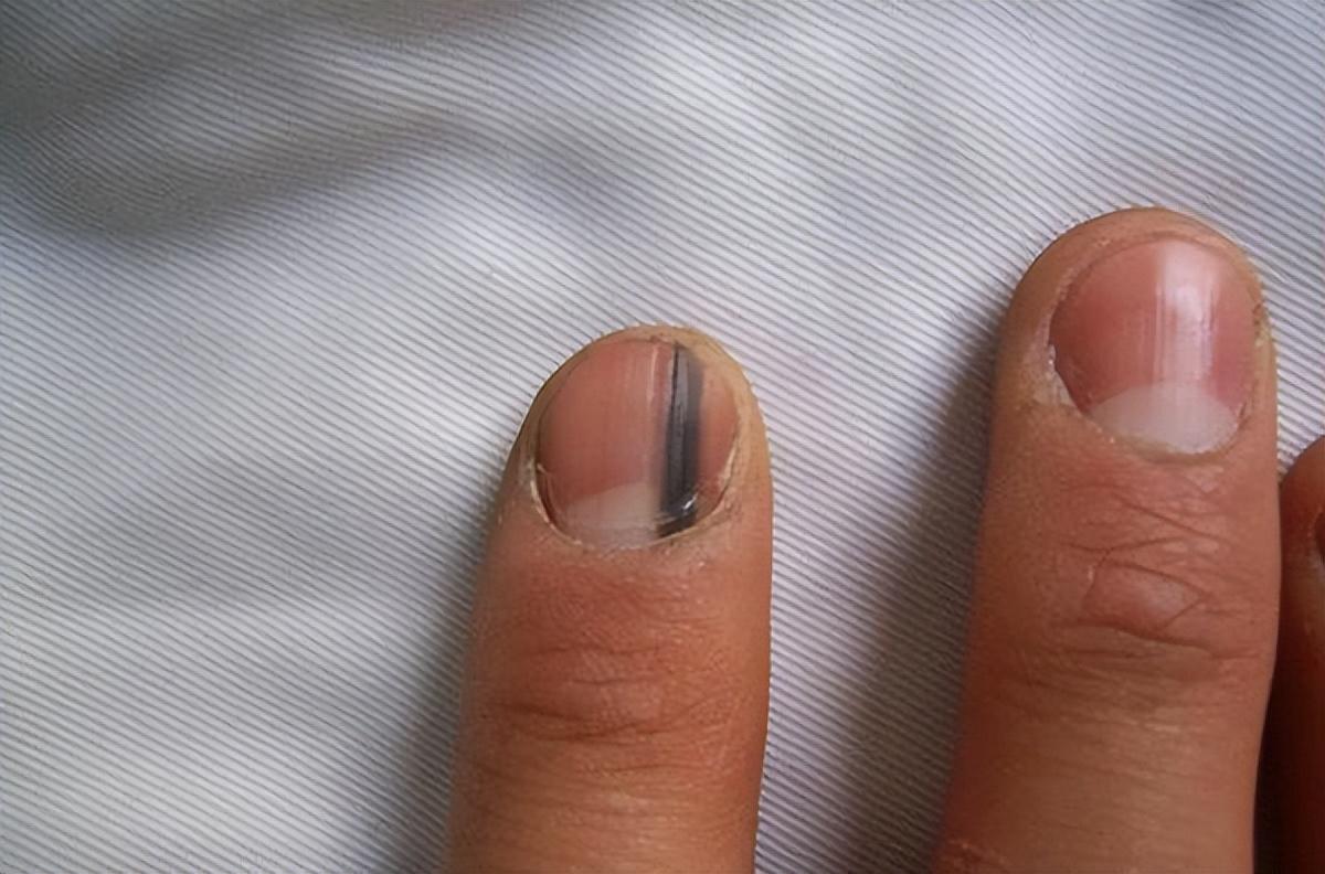 指甲白点,竖纹,月牙代表身体不健康?什么样的指甲是疾病的信号
