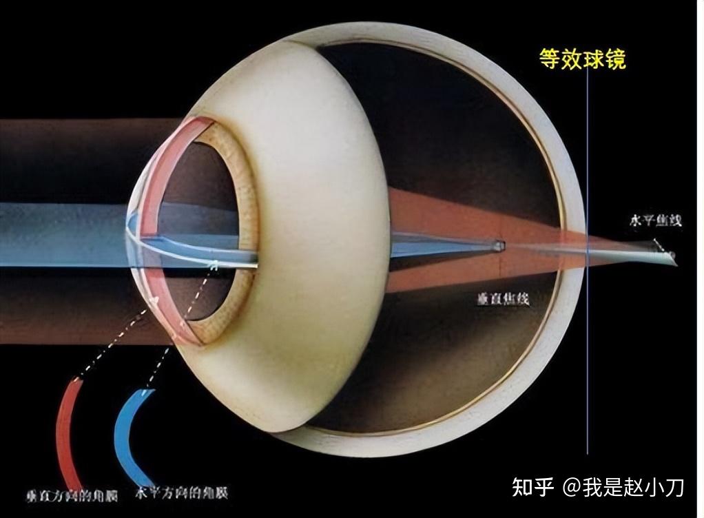 屈光球镜,柱镜,轴位图片