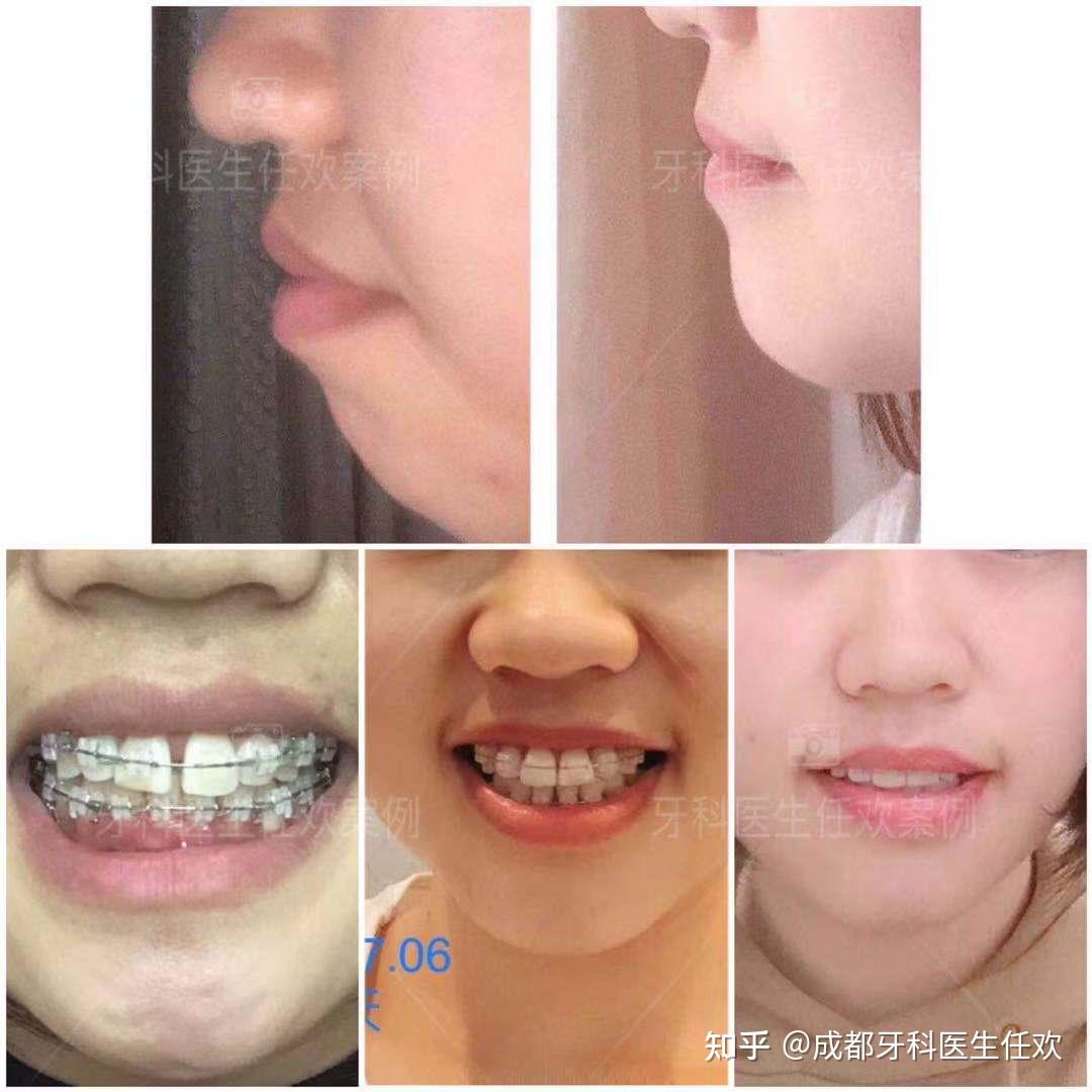 嘴突龅牙+下巴后缩+深覆合+开唇露齿矫正案例