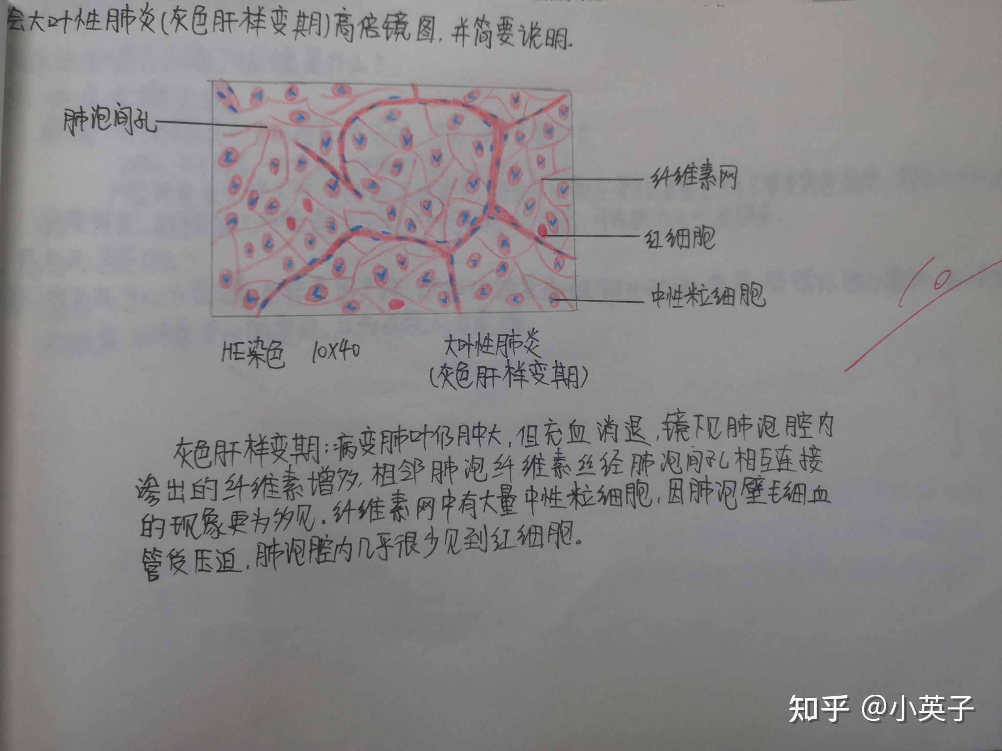 肝硬化合并肝细胞肝癌快速进行性肾小球肾炎低倍镜图结核结节高倍镜图