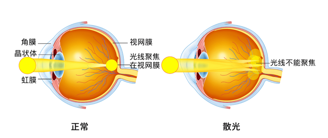 散光≠近视！小孩子眼睛散光应该怎么办？ - 知乎