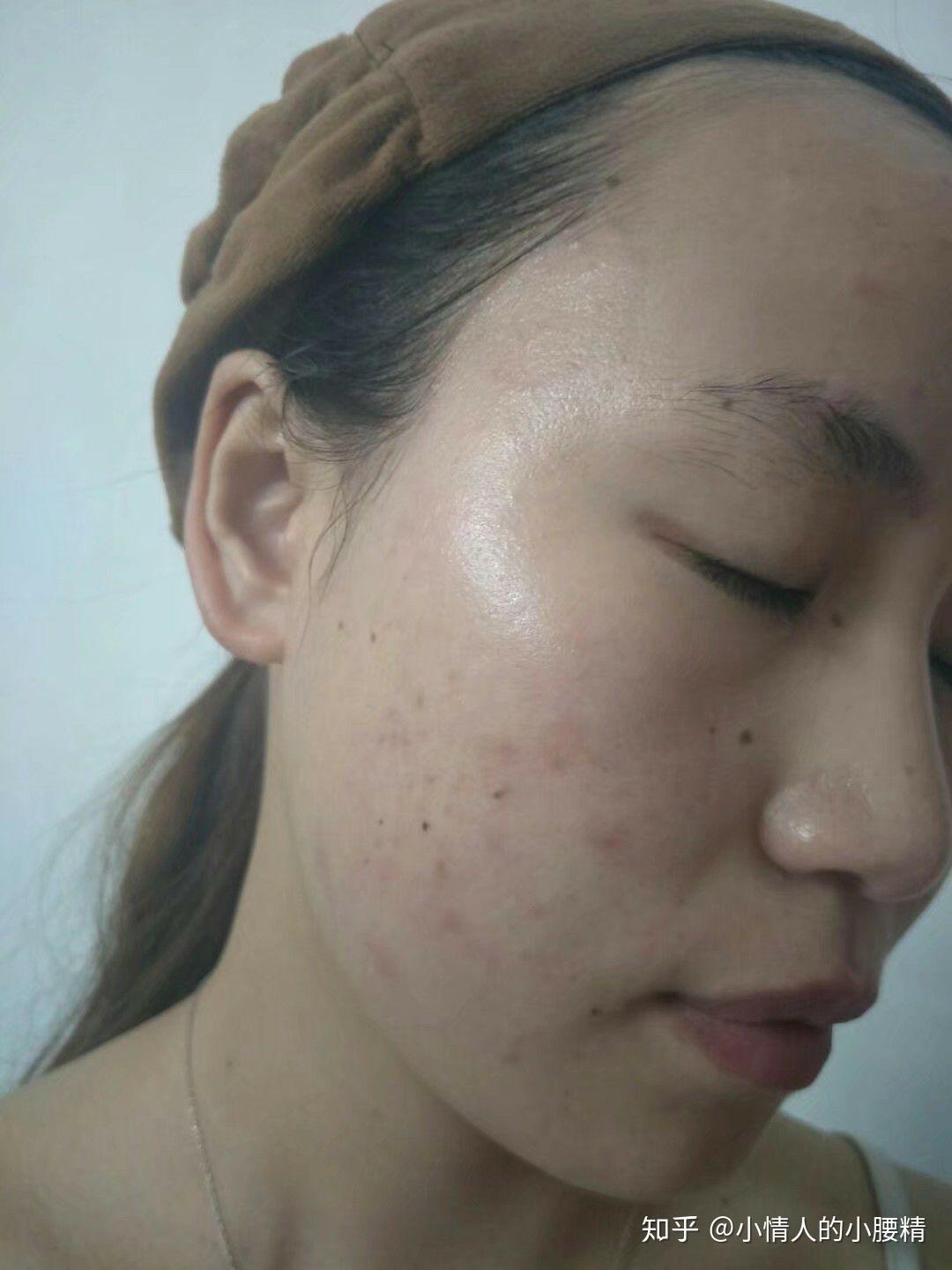皮肤出油就是油性皮肤吗?夏沫老师告诉你