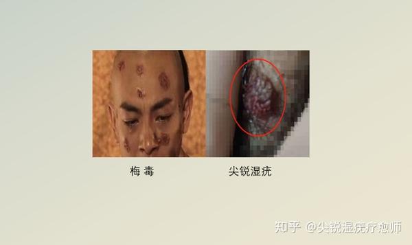 花柳病是什么症状 常见花柳病图片主要有哪几种 知乎