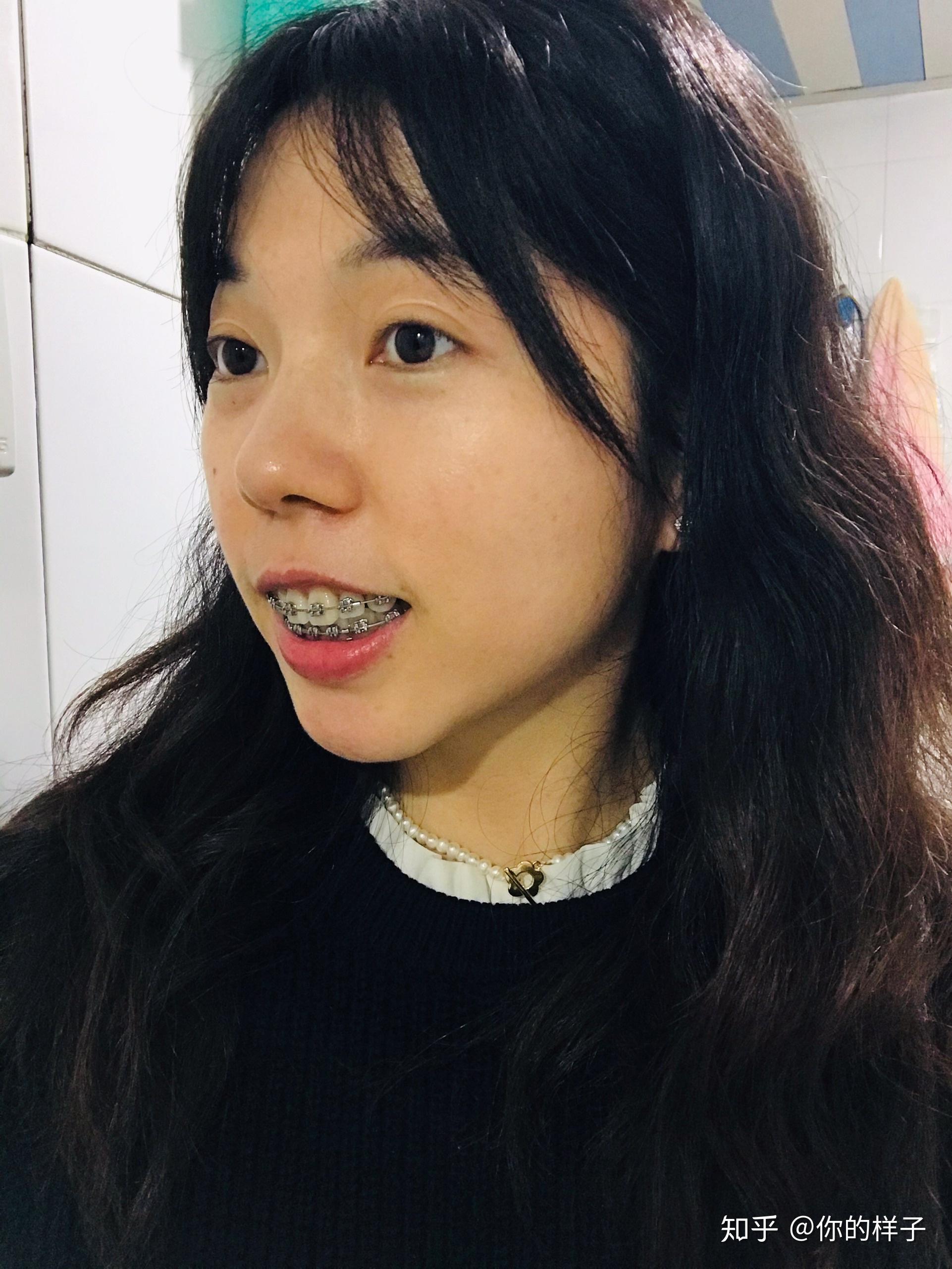 大龄女青年骨性嘴凸下巴后缩深覆合