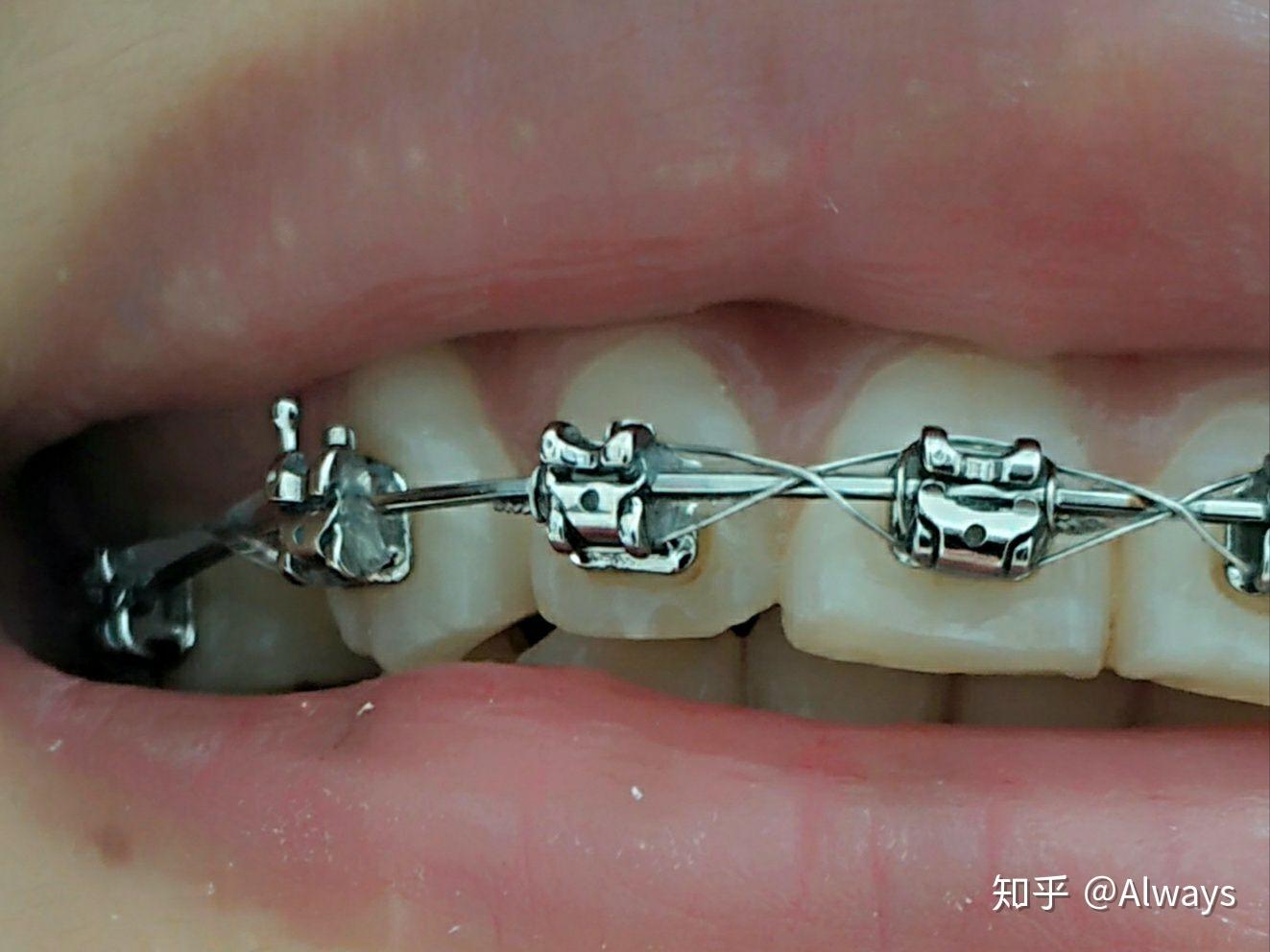 正畸矫正7422岁带自锁牙套的全过程