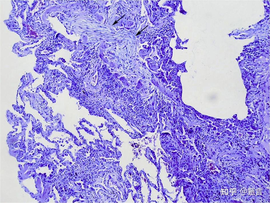 《ipf指南》药物治疗比较虽然吡非尼酮与尼达尼布已经用于ipf临床治疗