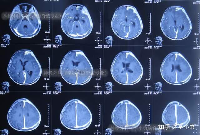 腦膜炎性顱內積膿去骨瓣開顱術後刀口仍流膿意識障礙不能走路轉至神經