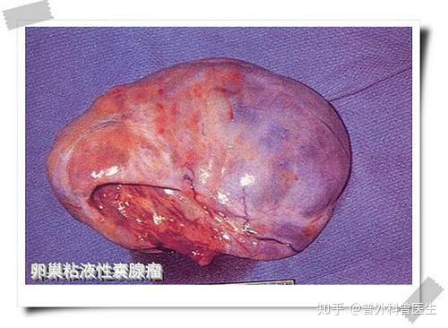 囊肿会变成肿瘤吗?囊肿和肿瘤有什么区别?医生告诉你答案