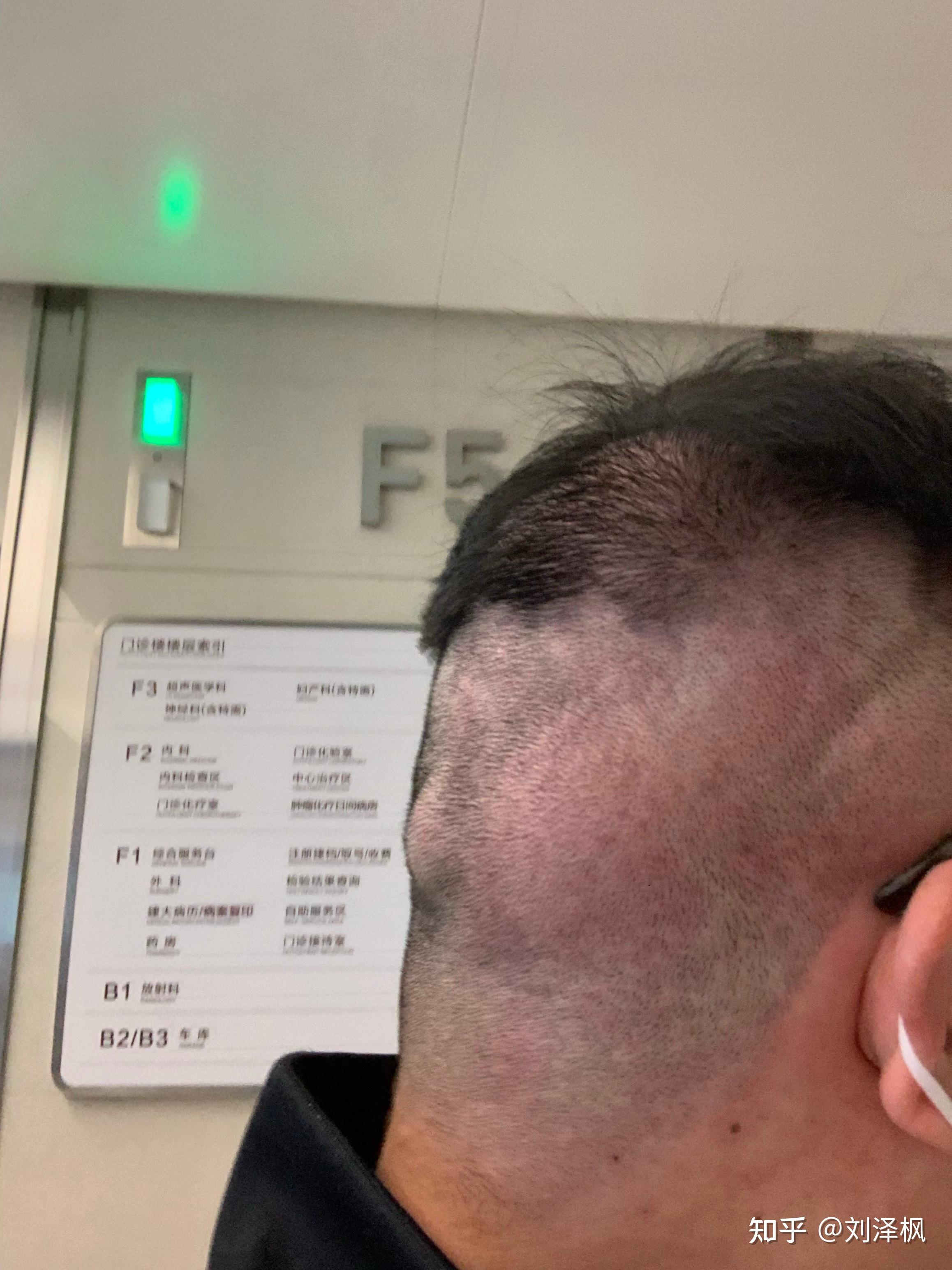 带状疱疹长脑袋上了