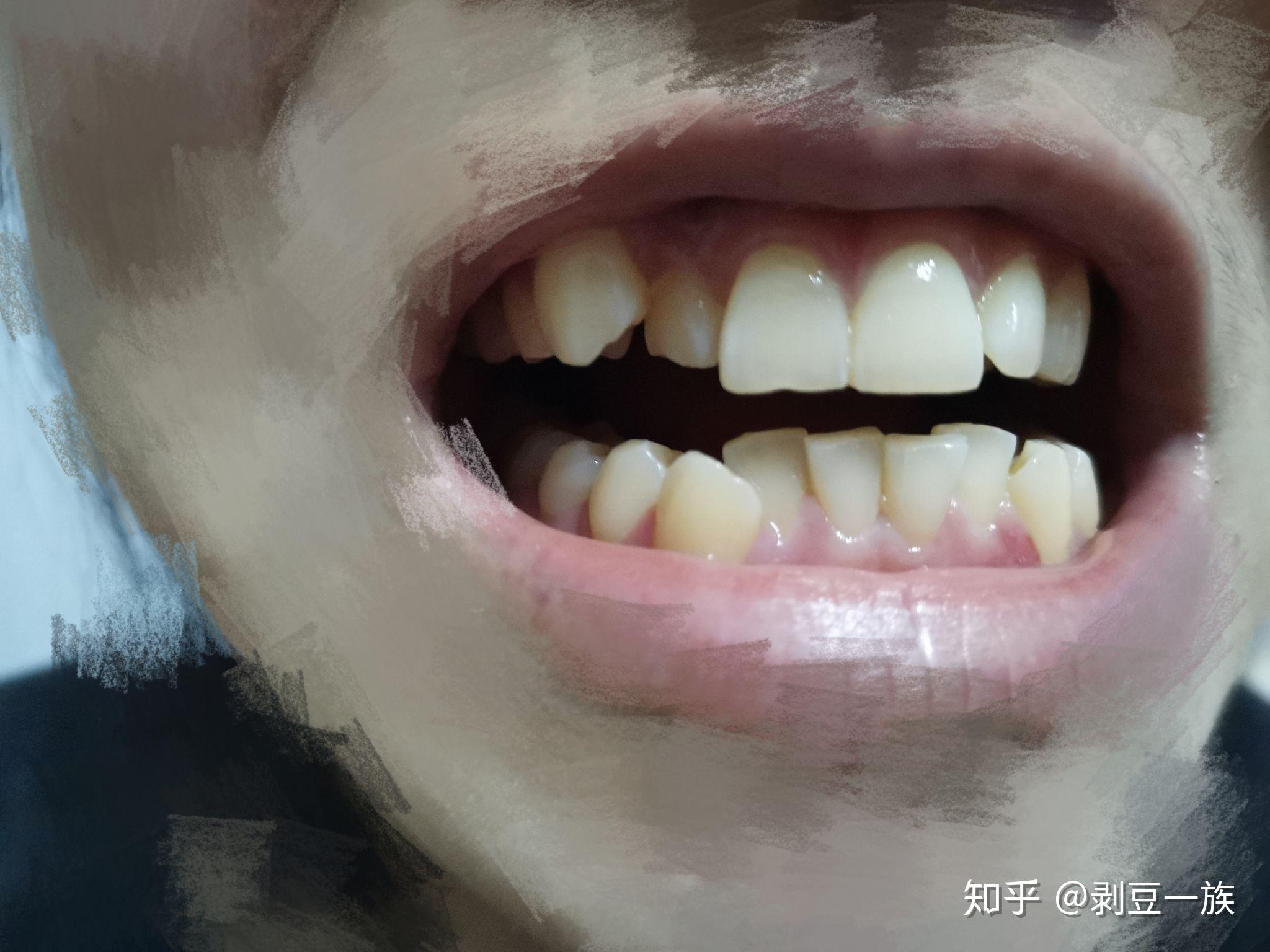 可以看到我的嘴巴是不能正常闭合的,有一点点飞牙齿小时候就有点自卑