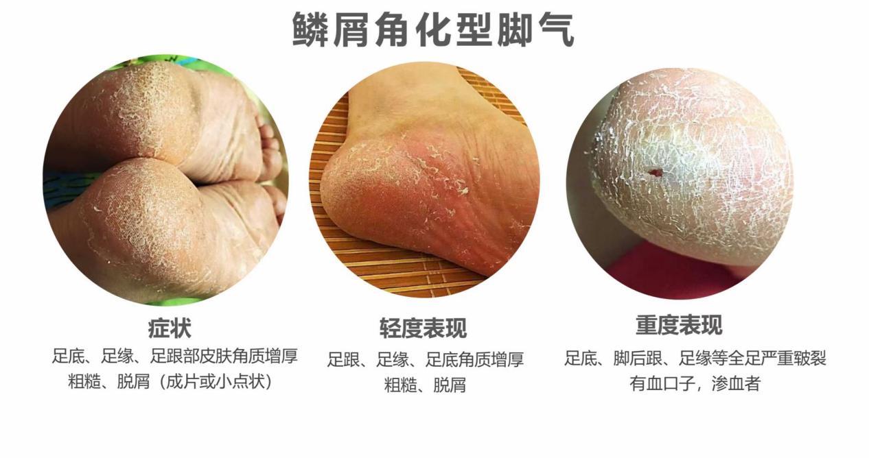 女朋友有脚气毛病该分手吗