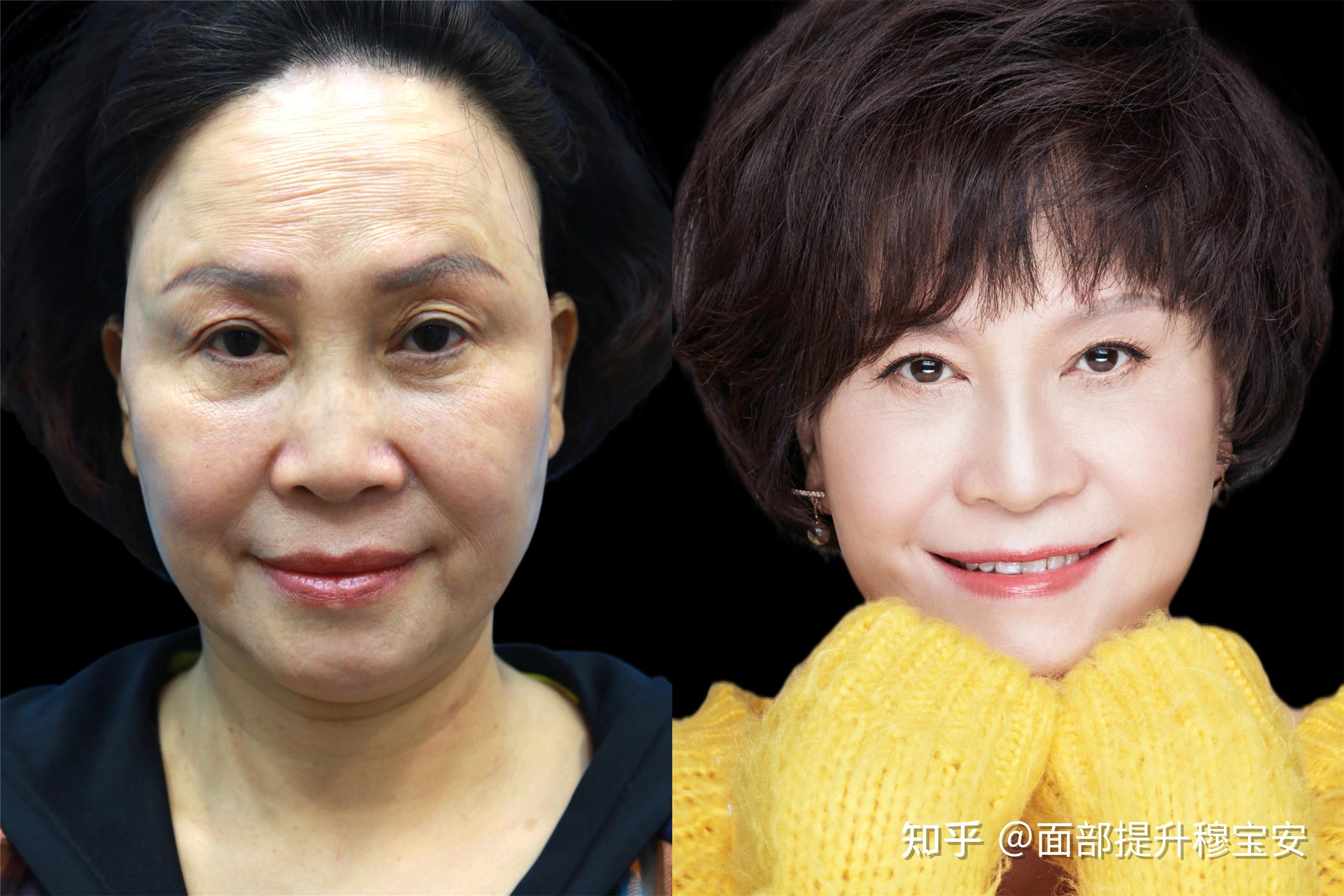 拉皮手术后 58岁老太太变40岁气质美女 - 知乎