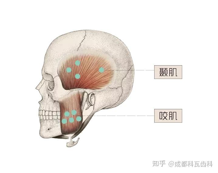 咀嚼肌群里的颞肌萎缩的后果就会导致太阳穴变凹,咬肌萎缩则可以使