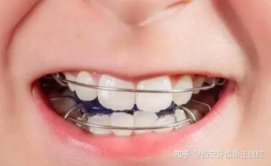 我国70%儿童患有错颌畸形,儿童牙齿矫正最佳年龄到底是啥时候?