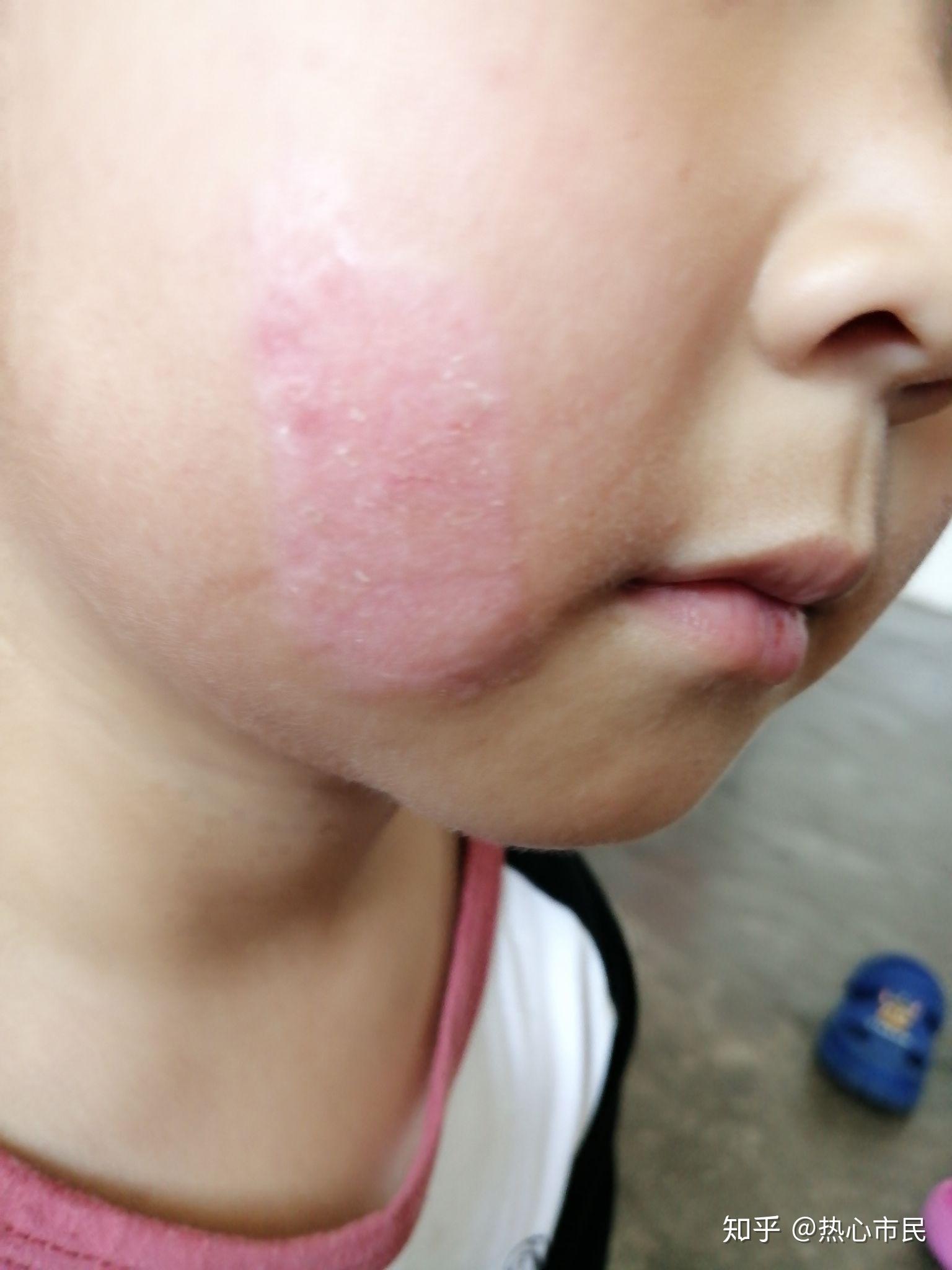 小孩脸部灼烧多久恢复