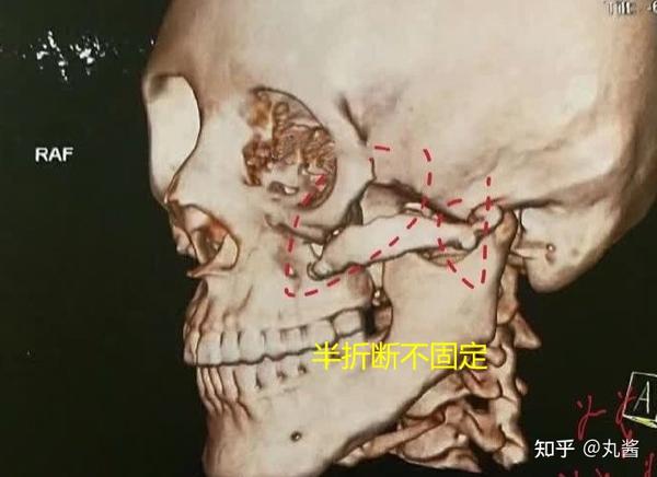 颧骨内推半折断不固定好还是全折断双端固定好？国内哪些医生做颧骨内推？ - 知乎