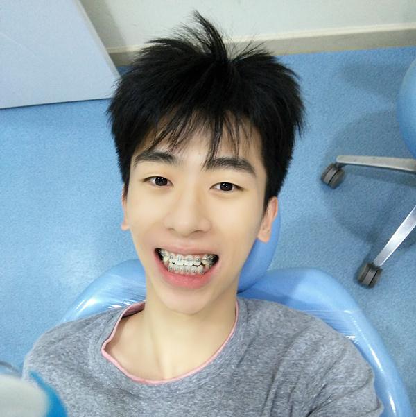 戴牙套10个月,变成这鬼样?戴牙套是要"趁早"的