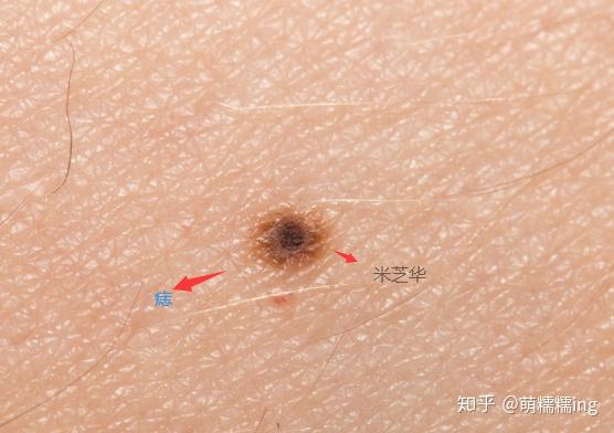 怎样才能做到不长痣 v2-eb7b111058ce6d9f23098c61e62c8f0e_r.jpg