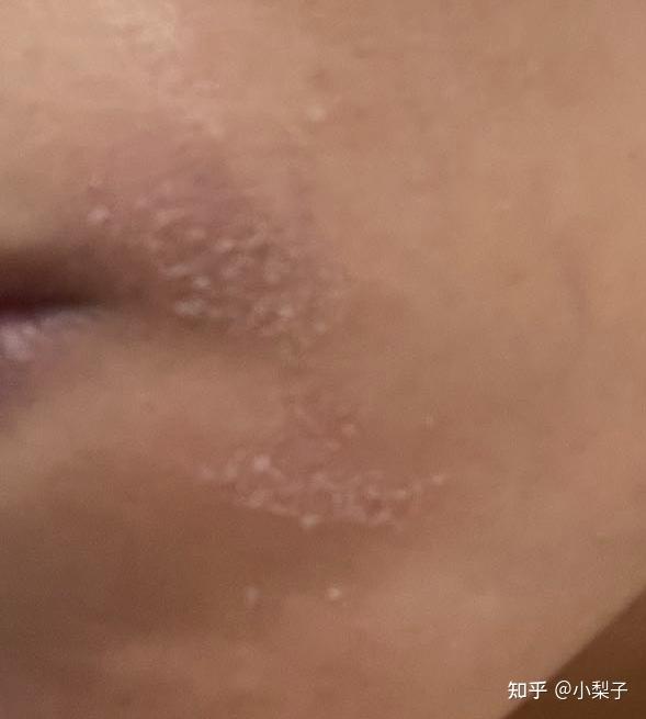 脂溢性皮热抗战历程_北京鼻部整形