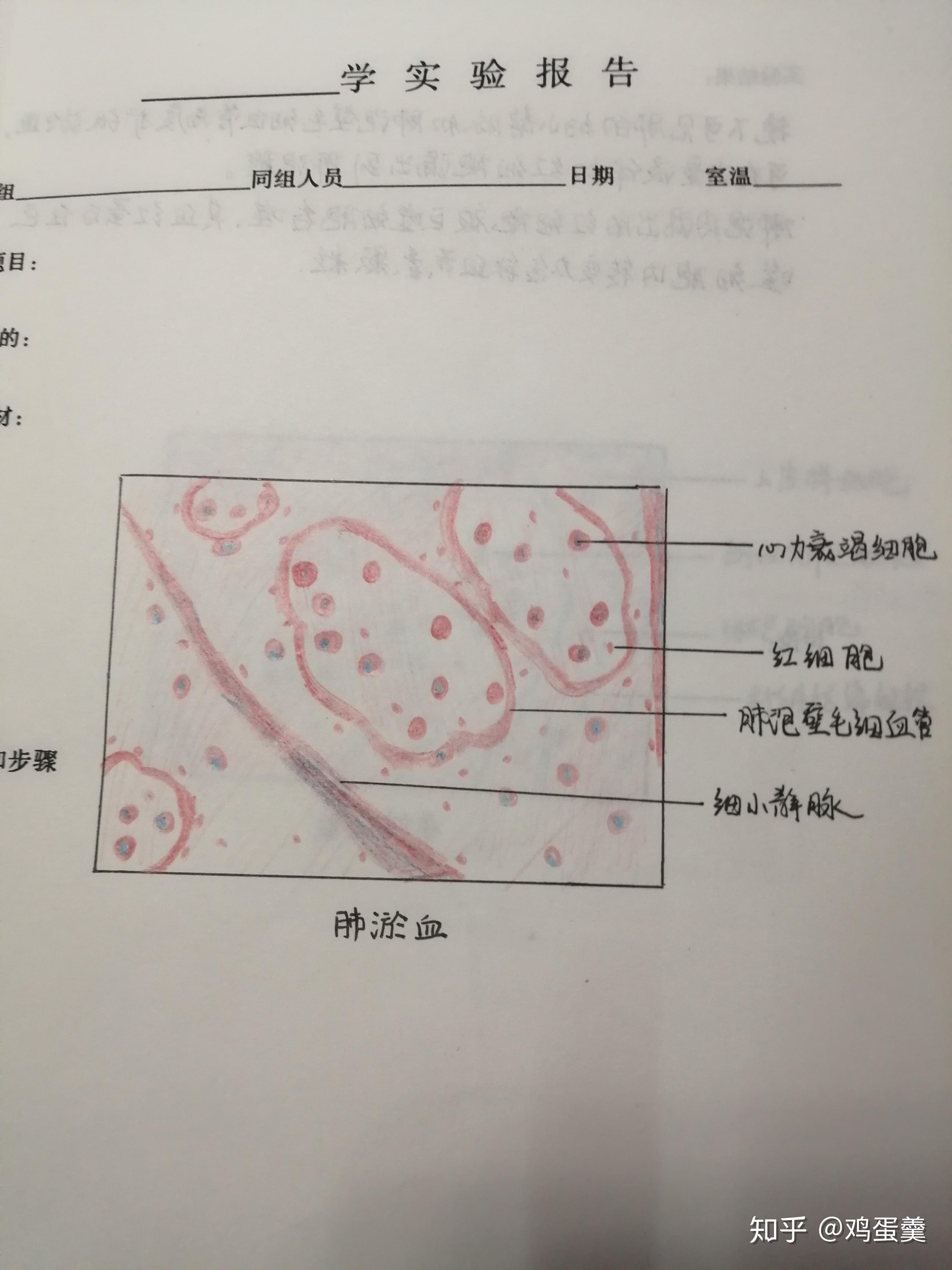 谁有慢性肺淤血高倍镜红蓝手绘图片吗