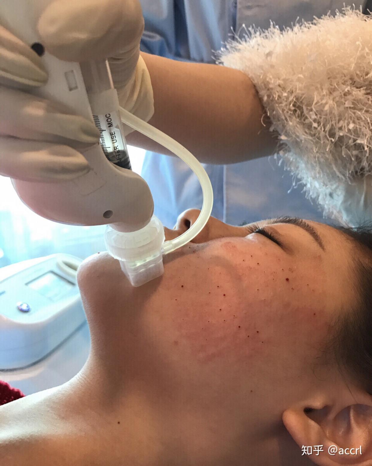 涂抹玻尿酸pk水光针,你选谁?