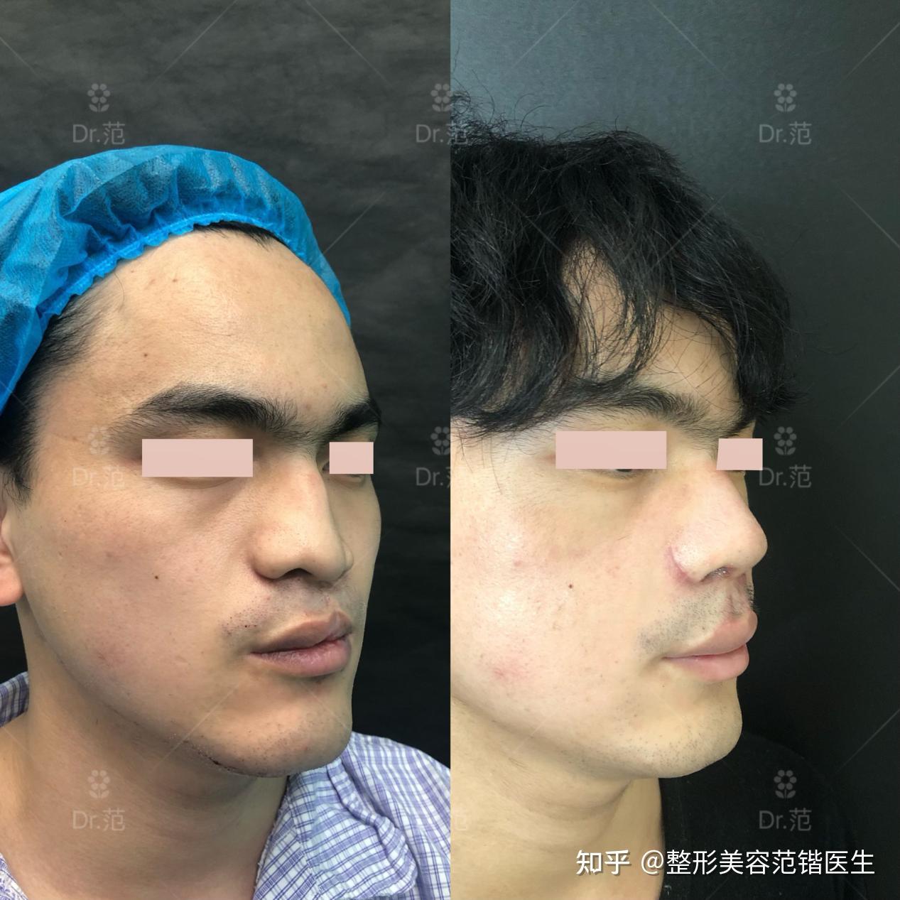 25岁,来自江苏徐州,患有先天性唇腭裂,婴儿时期做了一次修复手术,术后