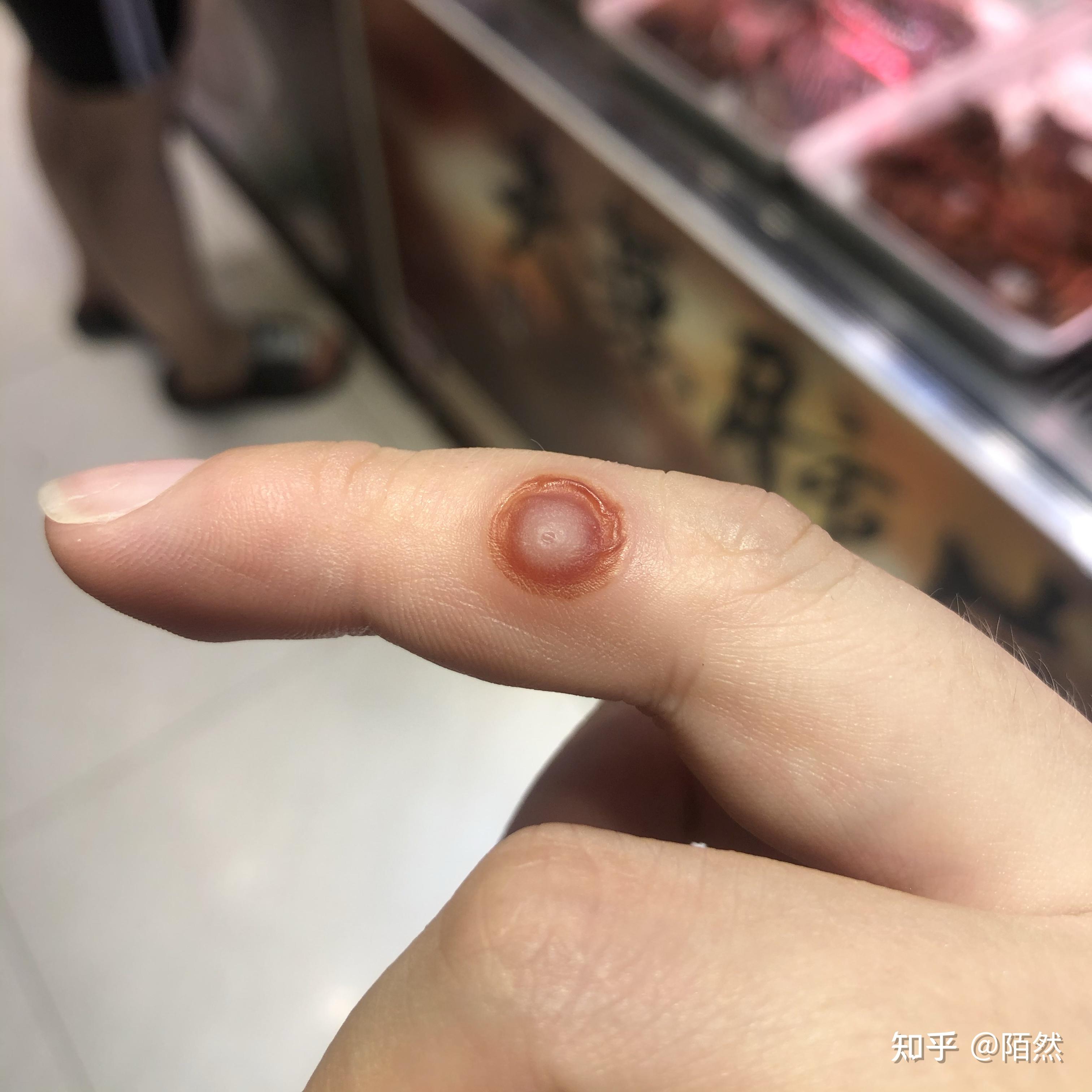 20 跖疣冷冻治疗恢复全过程,持续更新中!01