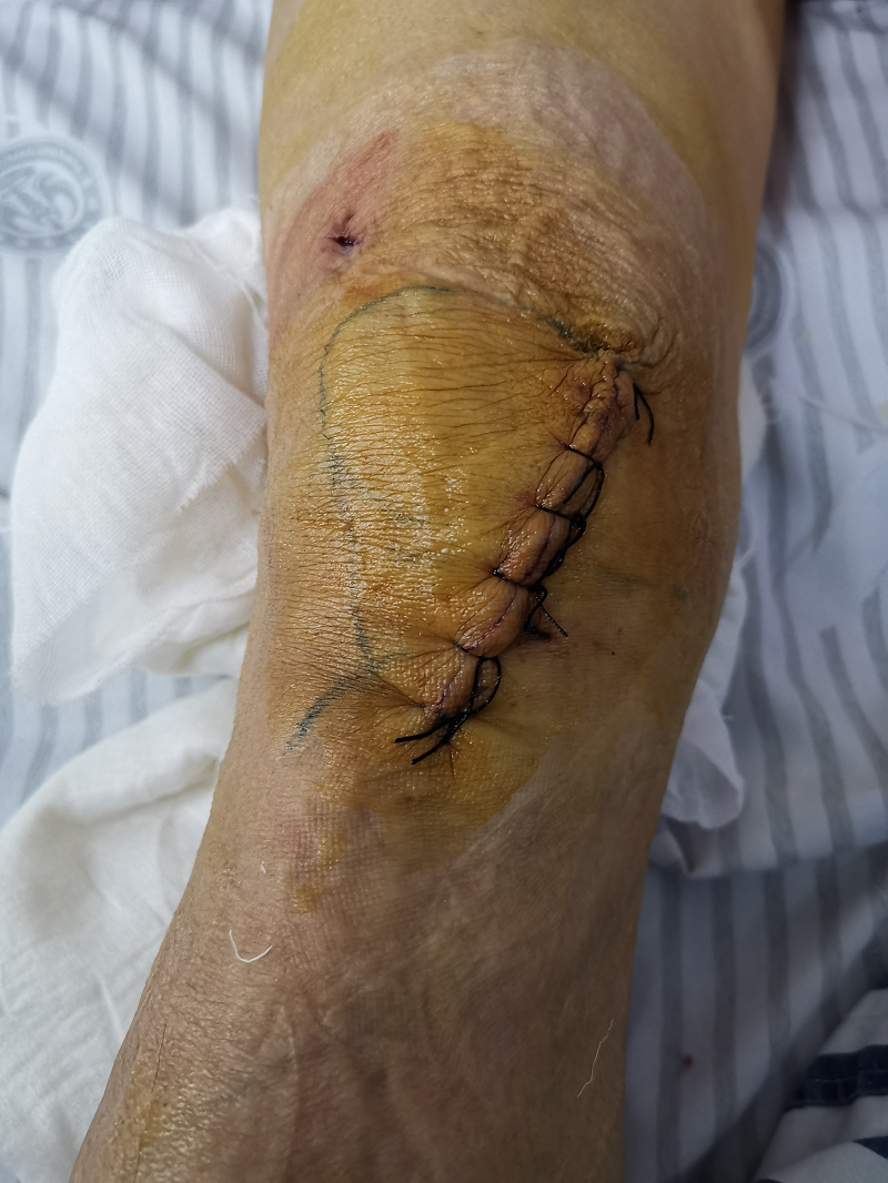 膝关节外侧关节面软骨及前叉韧带完好无损,适合行单髁置换术,最终手术